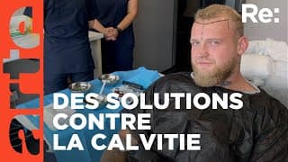[PUTAIN] Il passe de 2/10 à 8/10 après une GREFFE de CHEVEUX