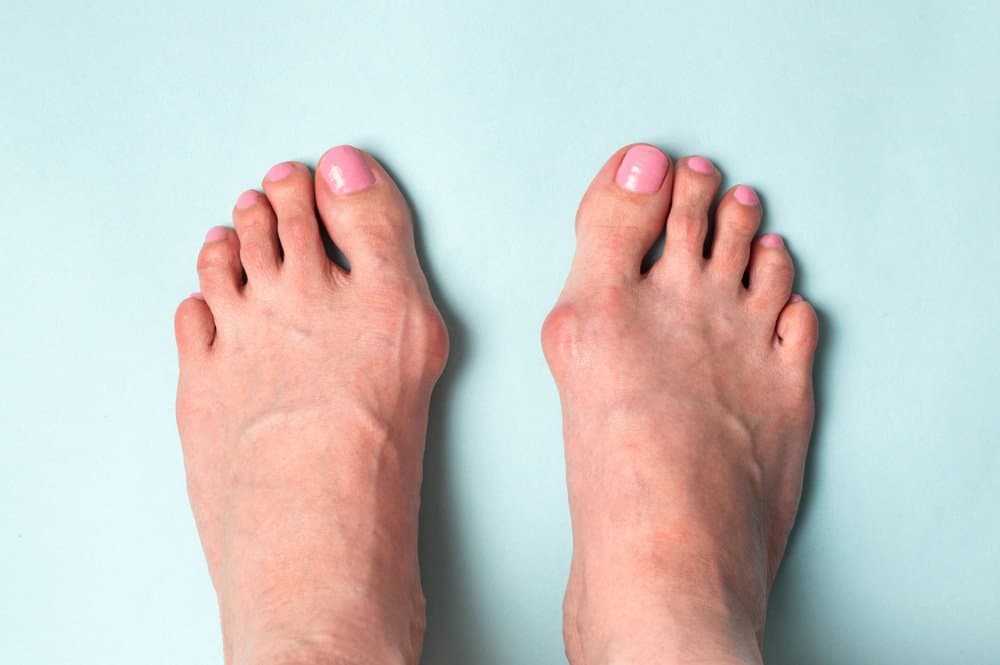 Les meufs avec un HALLUX VALGUS