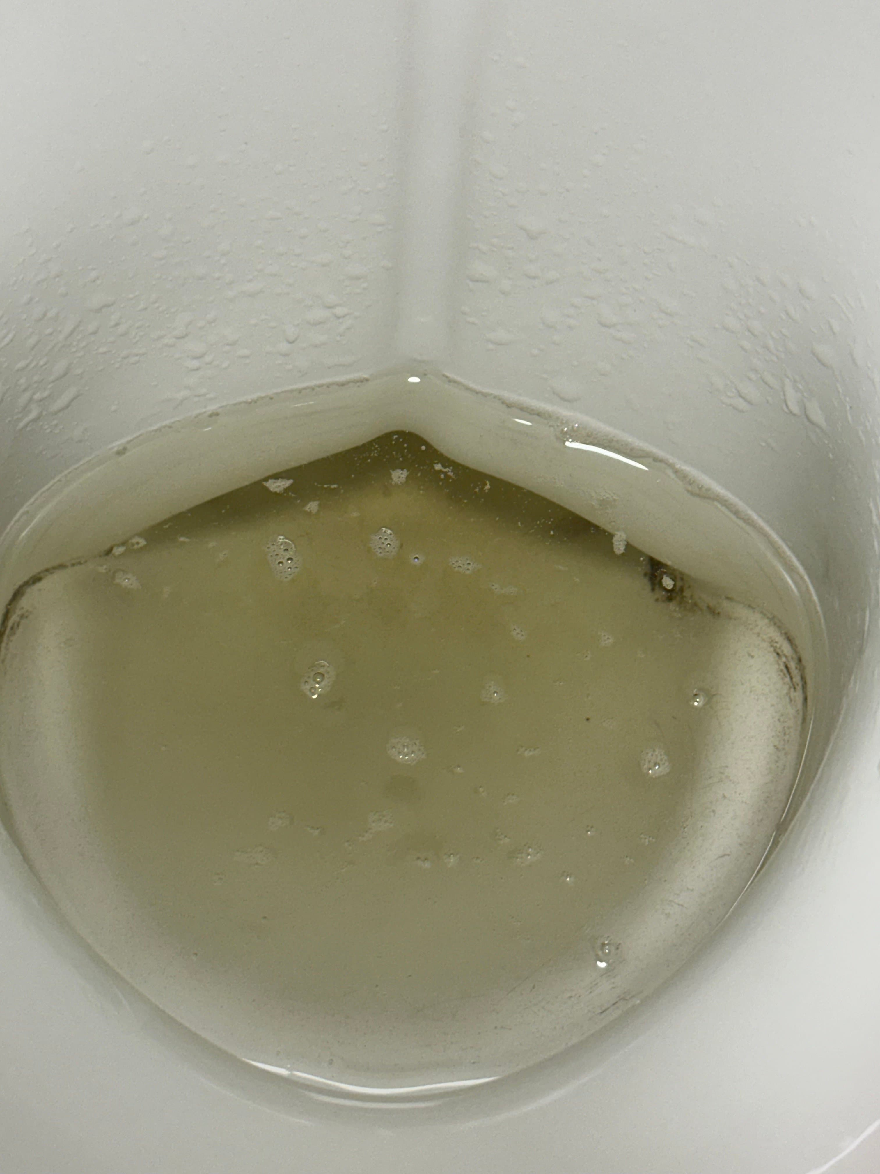 Pourquoi mon urine est comme ça ?