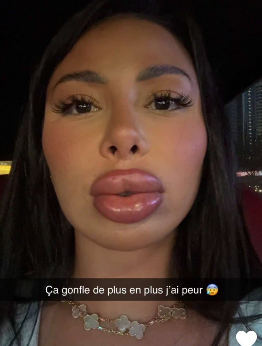 Photo : La teen Maeva Ghenam a fait refaire des lèvres