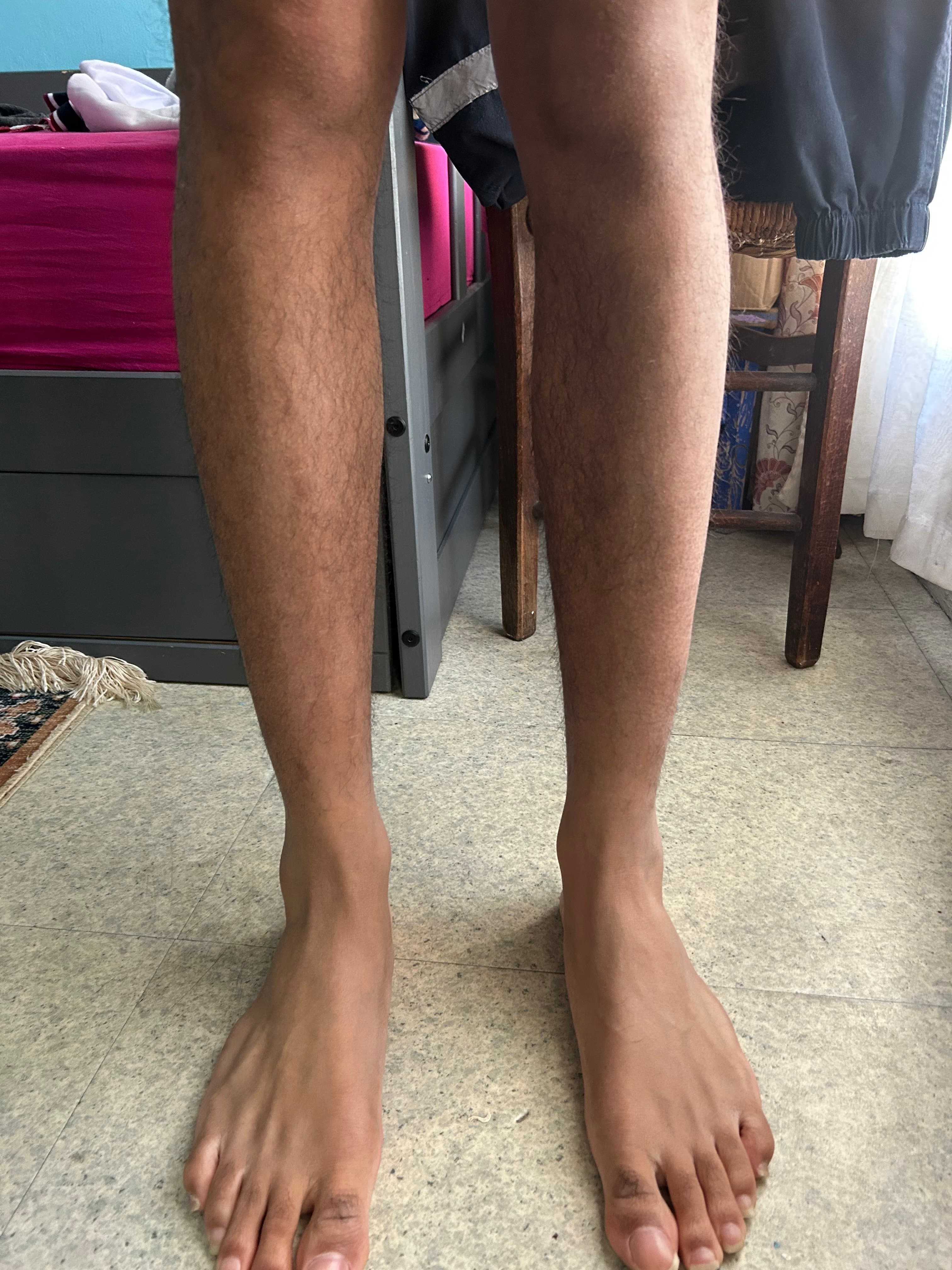 Atrophie du mollet ?