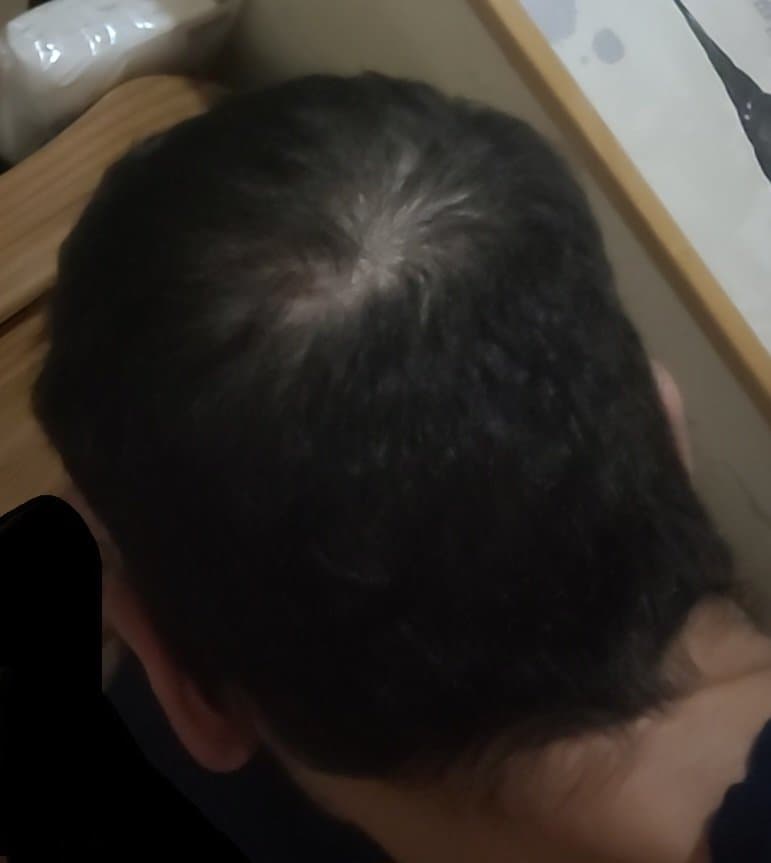 [PHOTO] Chatgpt me dit que je n'ai pas de CALVITIE