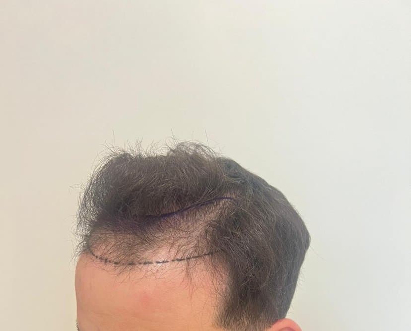 [PHOTOS] evolution de ma GREFFE de CHEVEUX en 6 mois