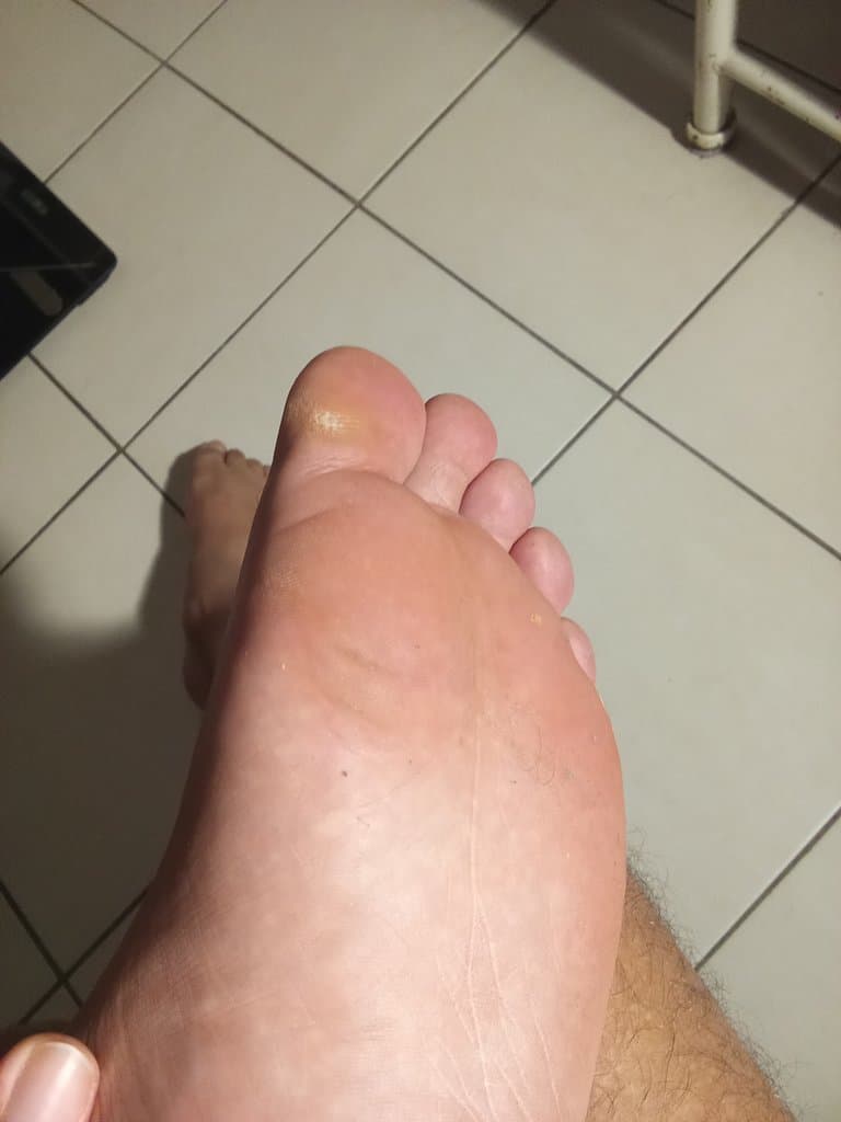 J'ai une énorme douleur au niveau du palme de mon pied
